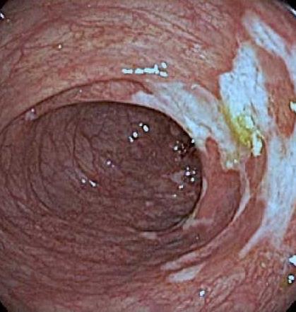P - Crohn's Colitis