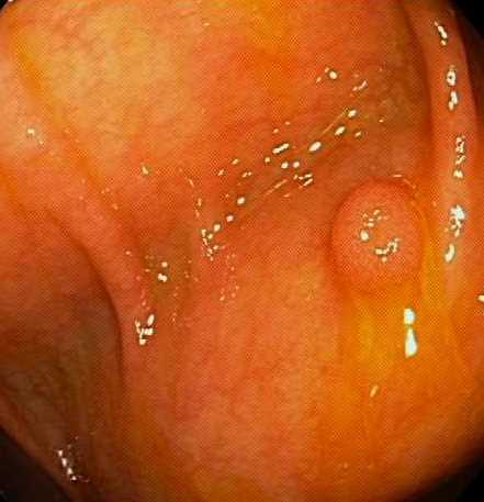 S - Polyp (small, hyperplastic, sessile)