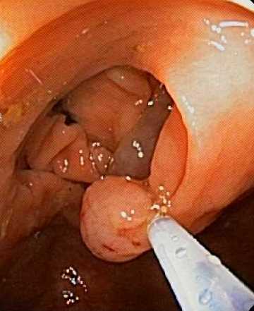 X - Polyp (removal with snare)