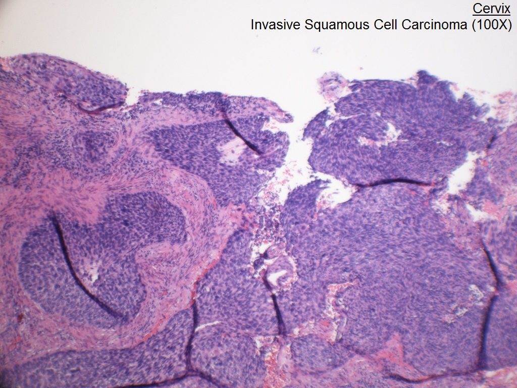 B - Cervix - Invasive Squamous Cell Carcinoma - 100X