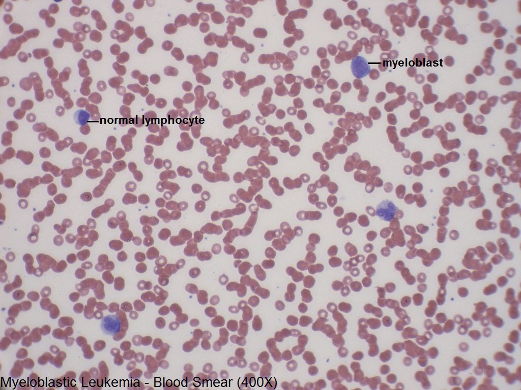 B - Myeloblastic Leukemia - Blood Smear - 400X - 2