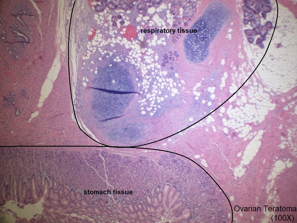 B - Ovarian Teratoma - Stomach Mucosa and Respiratory Passageway Tissue