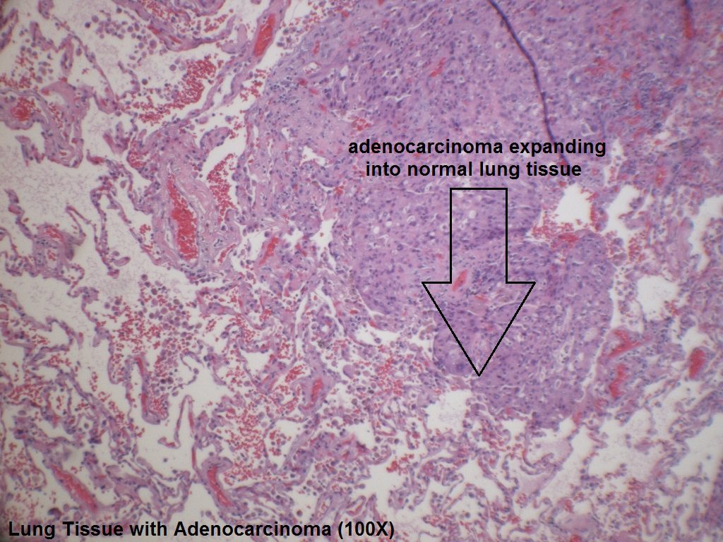 C - Adenocarcinoma Adjacent to Normal Lung Tissue - 100X