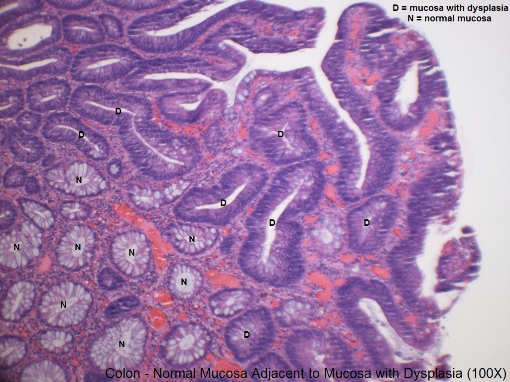 tubulovillous adenoma with dysplasia