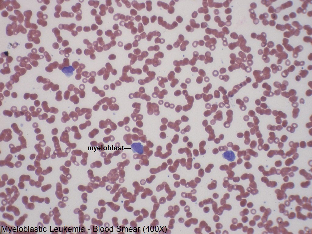 C - Myeloblastic Leukemia - Blood Smear - 400X - 3
