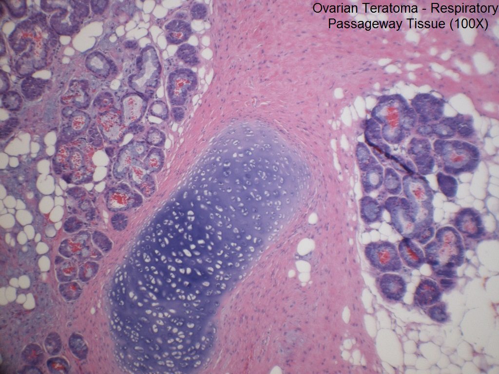 C - Ovarian Teratoma - Respiratory Passageway Tissue - 100X