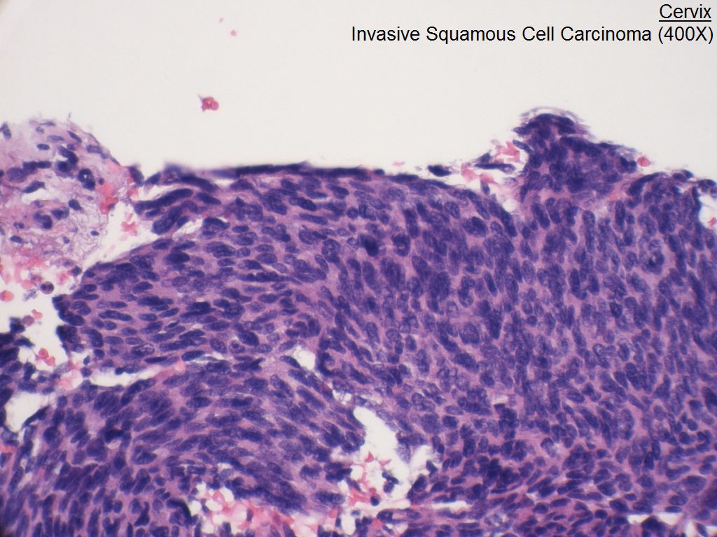 D - Cervix - Invasive Squamous Cell Carcinoma - 400X