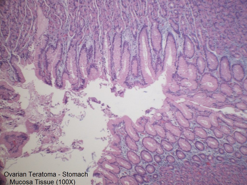 D - Ovarian Teratoma - Stomach Mucosa - 100X