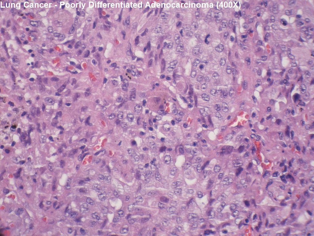 D - Poorly Differentiated Adenocarcinoma - 400X