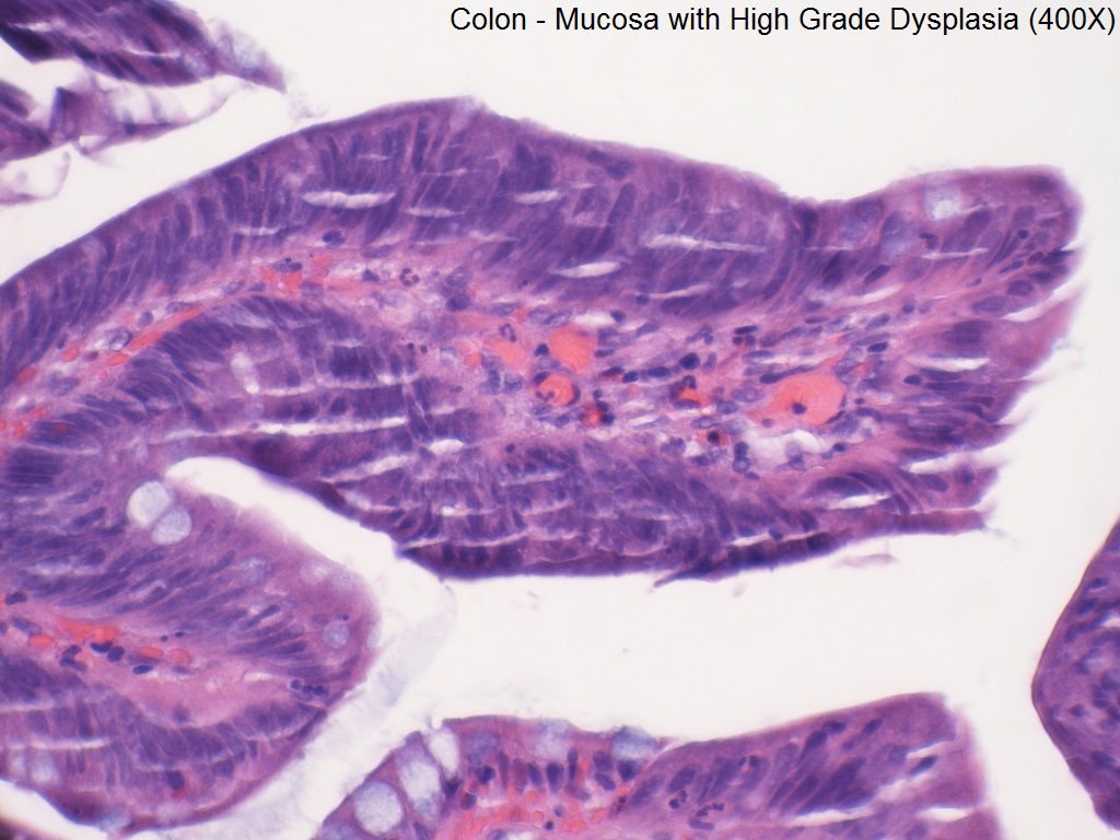 E - High Grade Dysplasia of Colon Mucosa - 400X