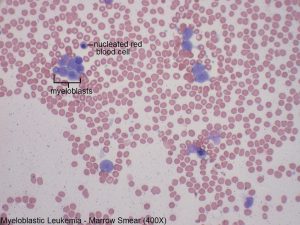 E - Myeloblastic Leukemia - Marrow Smear - 400X - 1