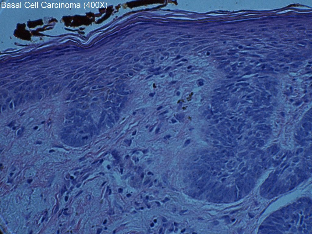 F - Basal Cell Carcinoma - 400X