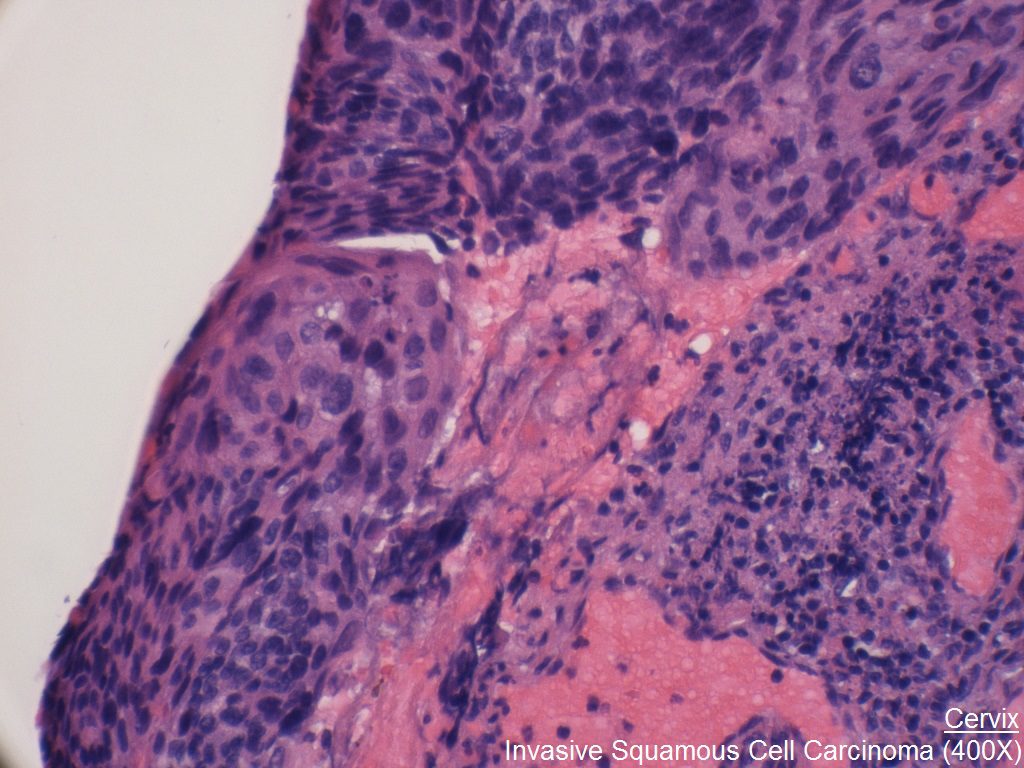 F - Cervix - Invasive Squamous Cell Carcinoma - 400X