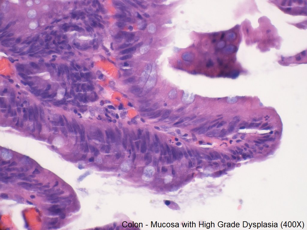 F - High Grade Dysplasia of Colon Mucosa - 400X