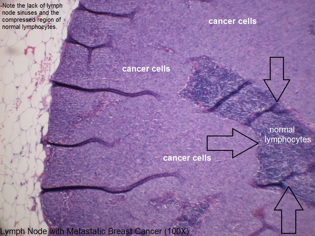 F - Lymph Node with Metastatic Breast Cancer - 100X