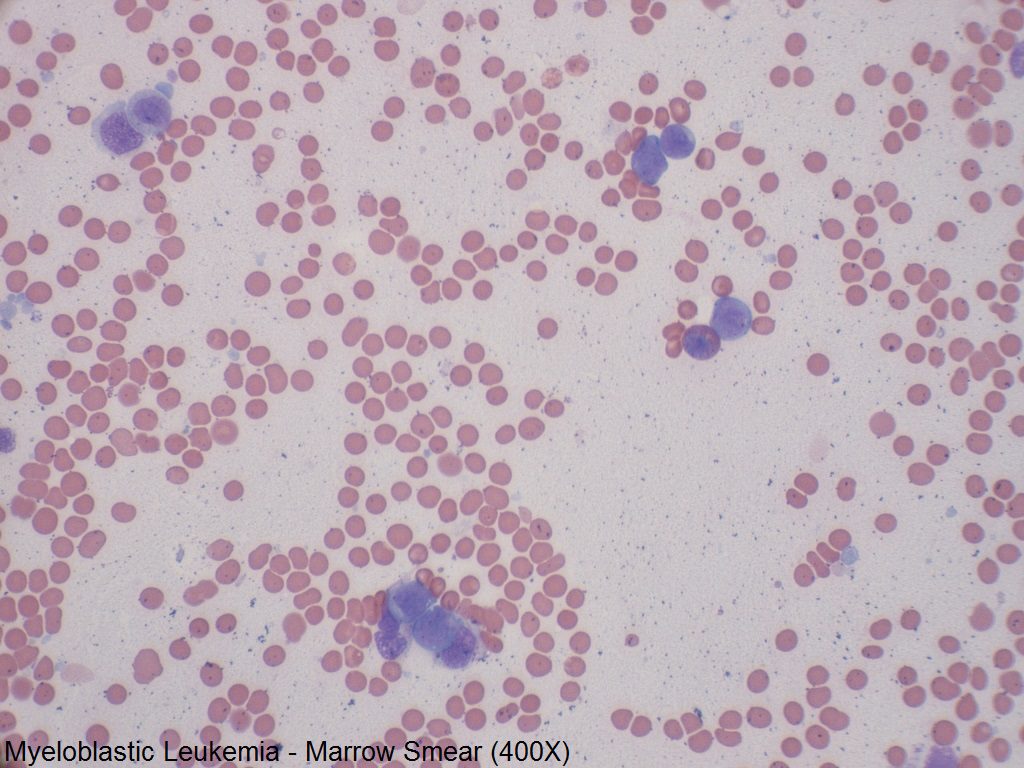 F - Myeloblastic Leukemia - Marrow Smear - 400X - 2