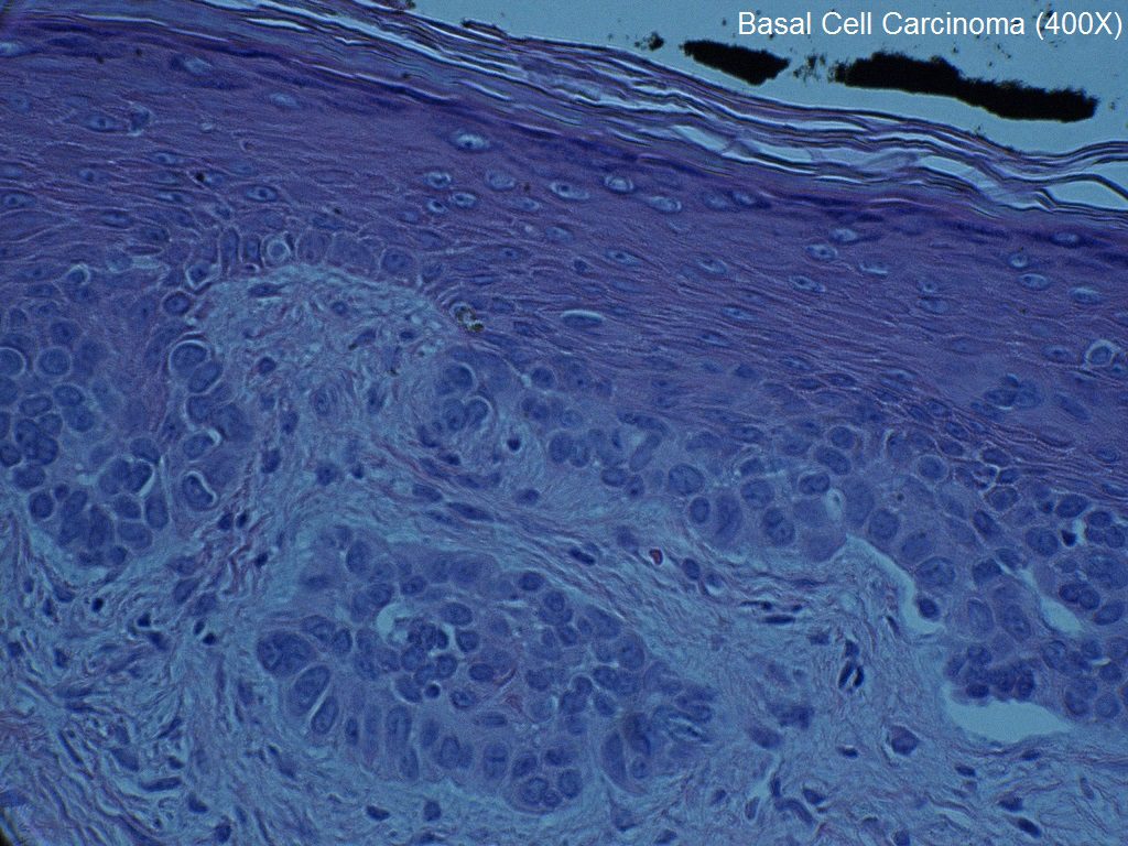 G - Basal Cell Carcinoma - 400X