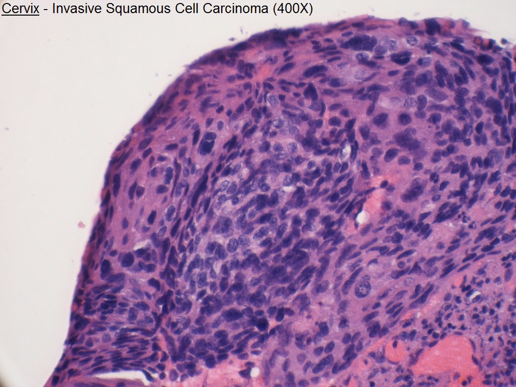 G - Cervix - Invasive Squamous Cell Carcinoma - 400X