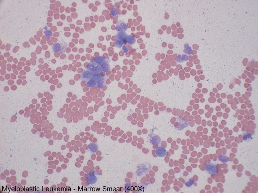 G - Myeloblastic Leukemia - Marrow Smear - 400X - 3