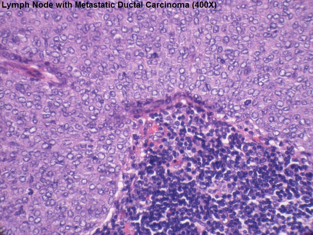 H - Lymph Node with Metastatic Ductal Carcinoma  - 400X