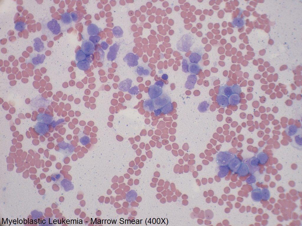 H - Myeloblastic Leukemia - Marrow Smear - 400X - 4