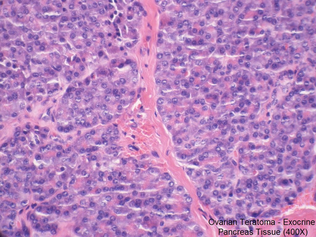 H - Ovarian Teratoma - Exocrine Pancreas - 400X