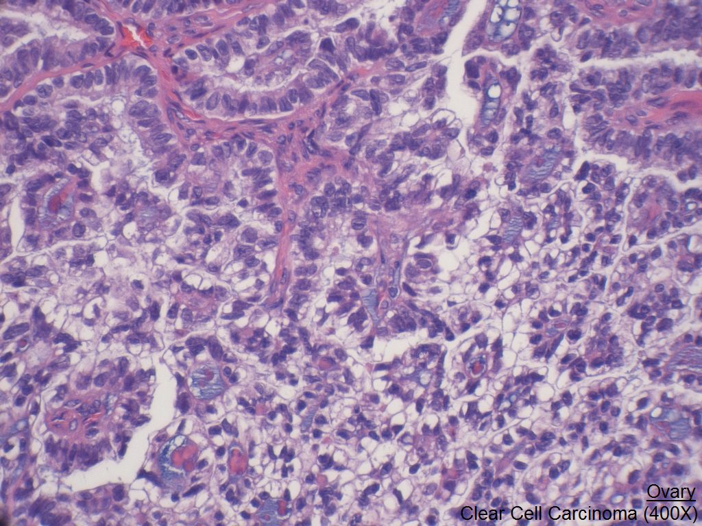 H - Ovary - Clear Cell Carcinoma 400X