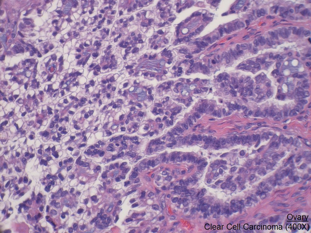 I - Ovary - Clear Cell Carcinoma 400X