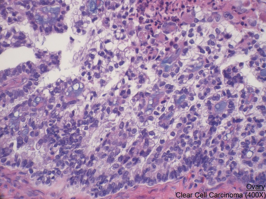 J - Ovary - Clear Cell Carcinoma 400X
