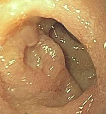 G- Ulcer- Duodenum