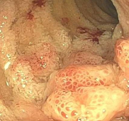 H- Crohn’s Ulcer Ileum