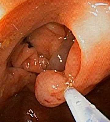 X- Polyp (removal with snare)