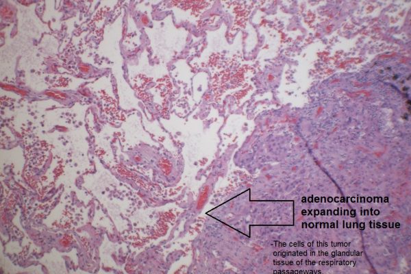 B – Adenocarcinoma Adjacent to Normal Lung Tissue – 100X