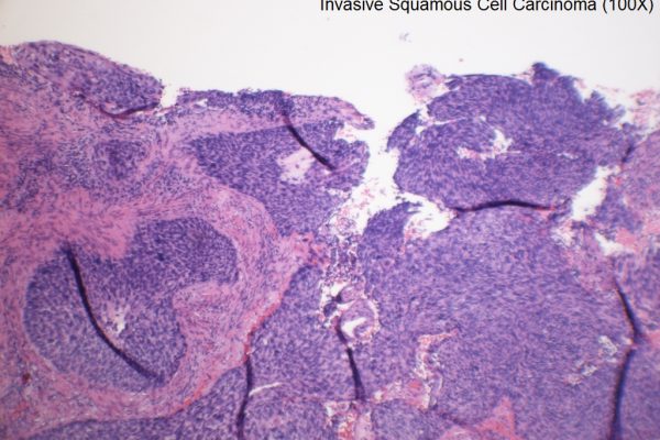 B – Cervix – Invasive Squamous Cell Carcinoma – 100X