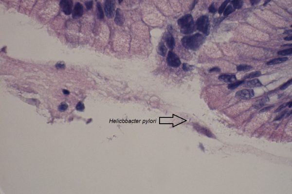 B – Helicobacter pylori – Gastric Mucosa – 1000X