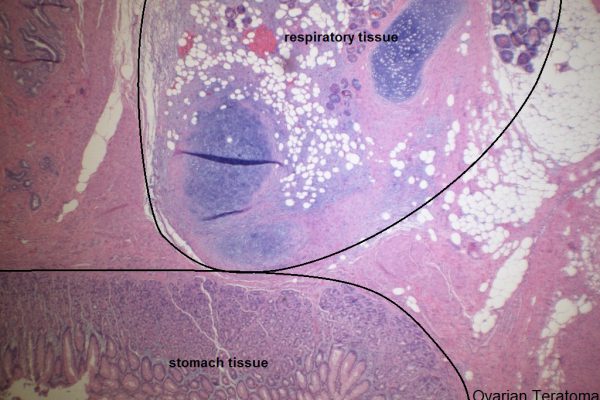 B – Ovarian Teratoma – Stomach and Respiratory Passageway Tissue
