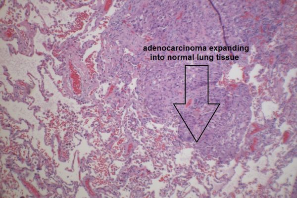 C – Adenocarcinoma Adjacent to Normal Lung Tissue – 100X