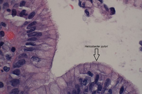 C – Helicobacter pylori – Gastric Mucosa – 1000X