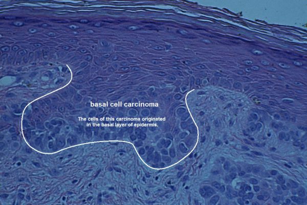 D – Basal Cell Carcinoma – 400X