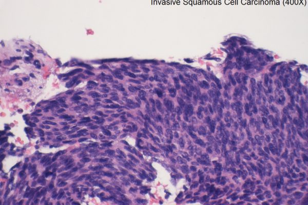 D – Cervix – Invasive Squamous Cell Carcinoma – 400X