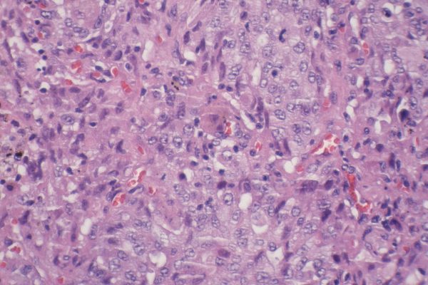 D – Poorly Differentiated Adenocarcinoma – 400X