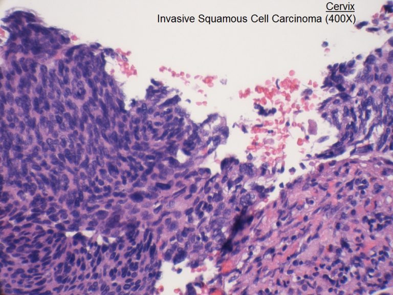 E Cervix Invasive Squamous Cell Carcinoma 400x 