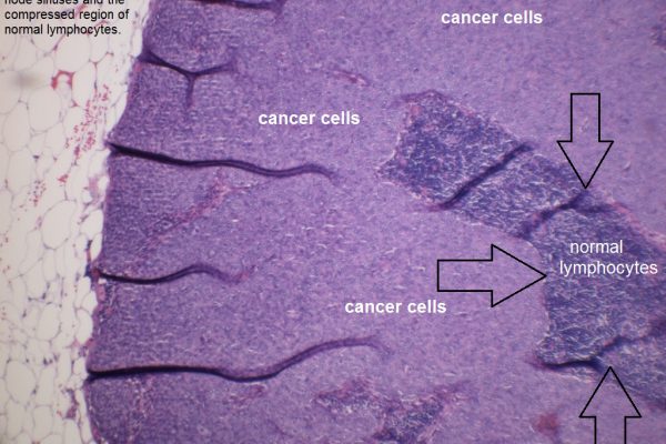 F – Lymph Node with Metastatic Breast Cancer – 100X