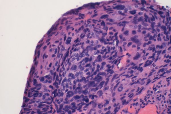 G – Cervix – Invasive Squamous Cell Carcinoma – 400X