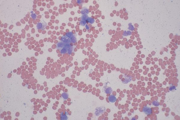 G – Myeloblastic Leukemia – Marrow Smear – 400X – 3
