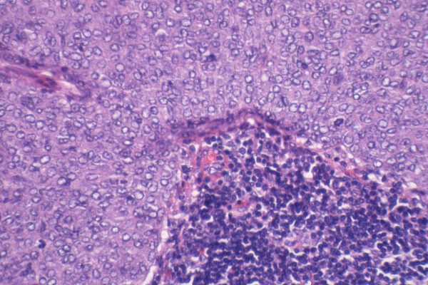 H – Lymph Node with Metastatic Ductal Carcinoma – 400X