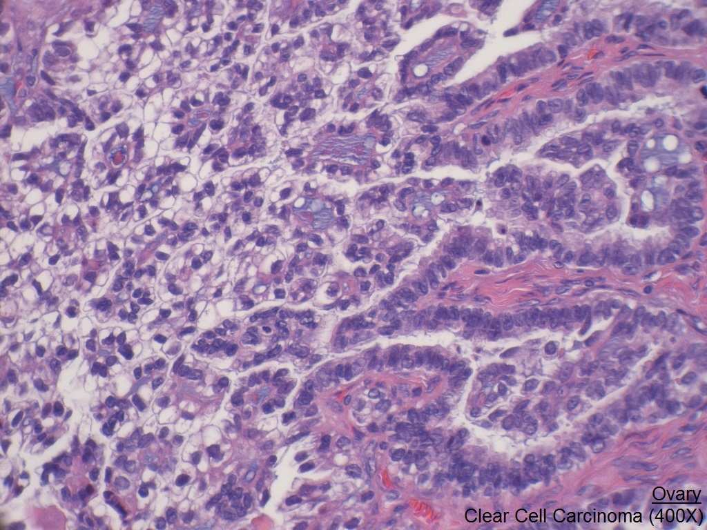 I Ovary Clear Cell Carcinoma 400x