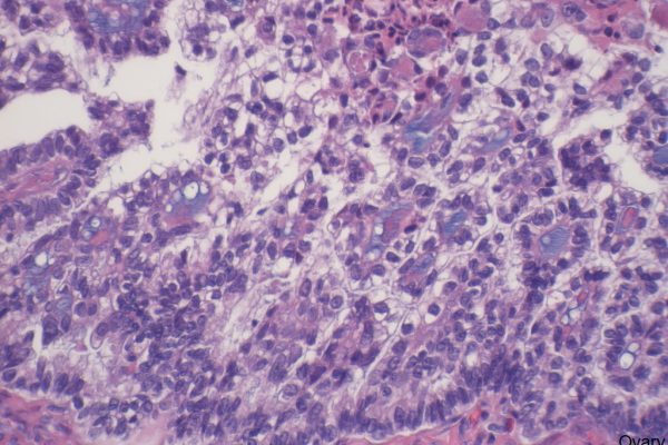 J – Ovary – Clear Cell Carcinoma 400X